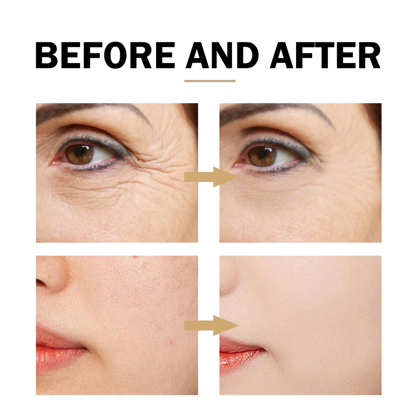 Before and after comparison of facial skin with wrinkle reduction and acne treatment.