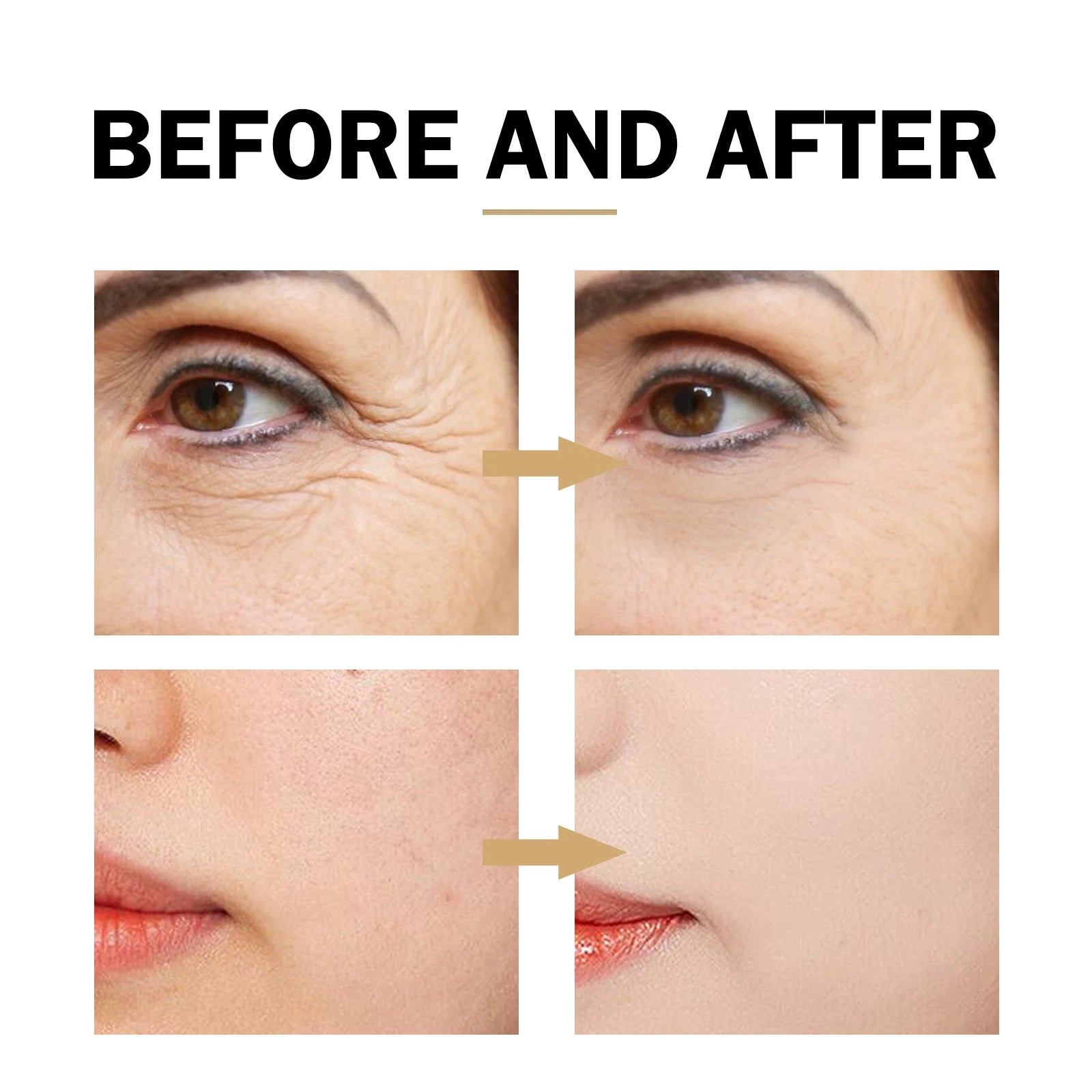Before and after comparison of facial skin with wrinkle reduction and acne treatment.